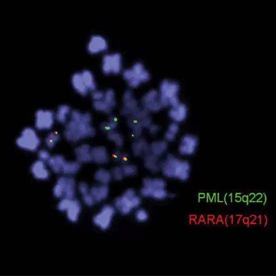 pml rara t(15;17 )(q22;q12) gene rearrangement quantitative mrd monitor test